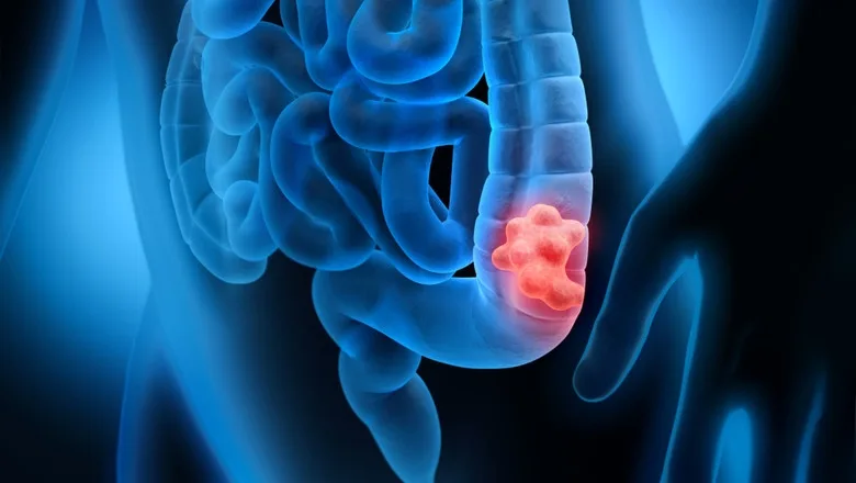 Cancer de colon din cauza antibioticelor
