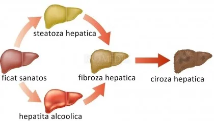 Riscul de deces din cauza hepatitei asociate alcoolului identificat acum cu o precizie înaltă